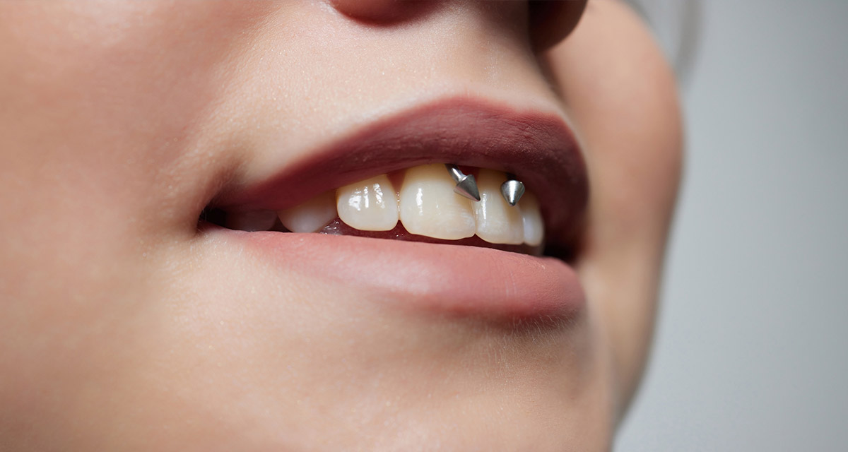 Piercing na boca: conheça os riscos para a sua saúde bucal